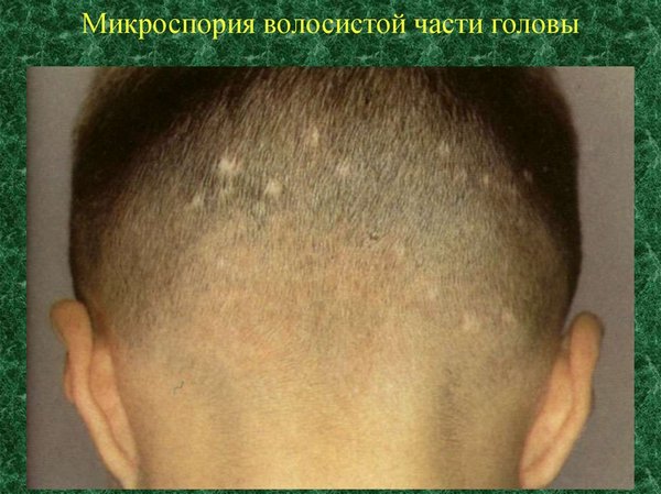 Mikrosporiya-na-golove-gribkovye-zabolevaniya-kozhi-klassifikaciya-simptomy-principy-lecheniya