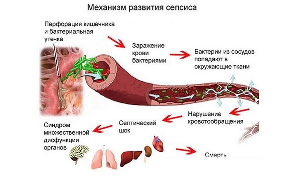 Sepsis-pri-stafilokokkovaya-infekciya-lechenie