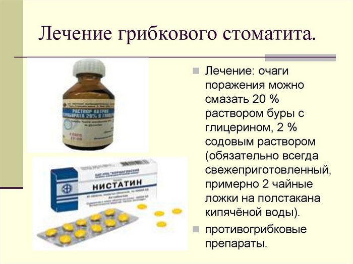 lechenie-gribkovogo-stomatita-preparaty