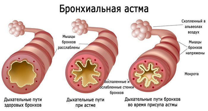 bronhialnaya-astma-i-koronavirus