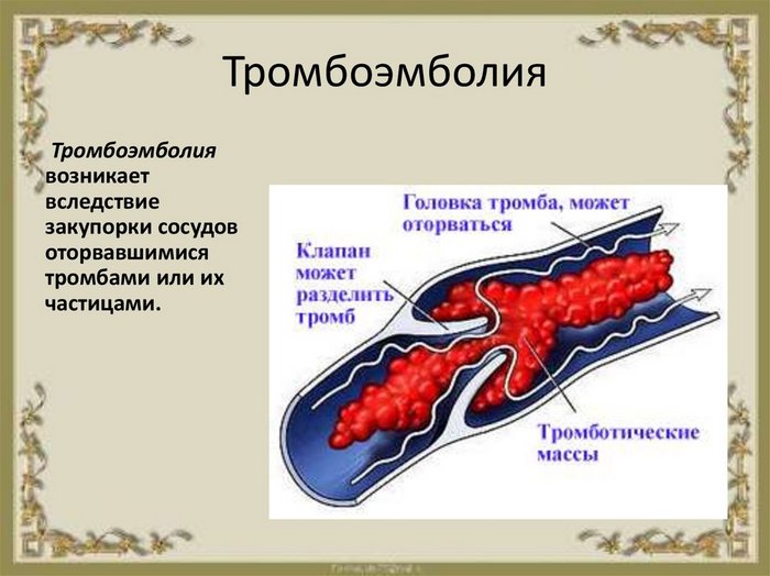 vliyanie-koronavirusnyh-shtammov-tromboehmboliya