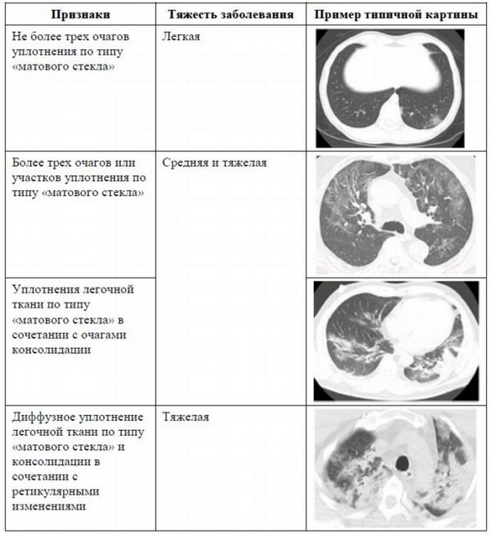 bolit-spina-pri-koronaviruse-temperatury-net-pnevmoniya-snimki-rentgen